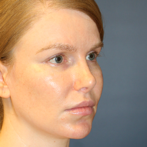 18-24 year old woman treated with Rhinoplasty after 3559795