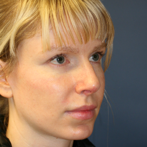 18-24 year old woman treated with Rhinoplasty before 3559795