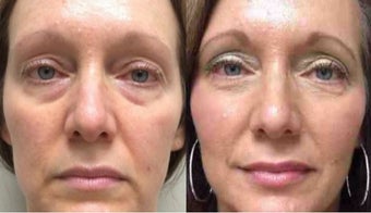 Droopy face fix before 2141563