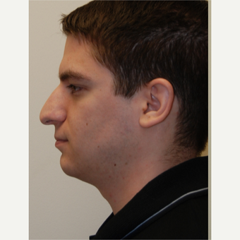 25-34 year old man treated with Rhinoplasty before 3792796