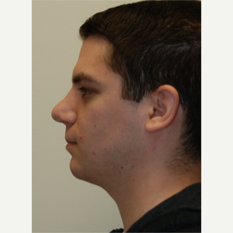 25-34 year old man treated with Rhinoplasty after 3792796