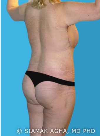 Body Lift 216789