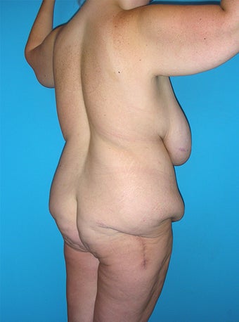 Body Lift 216789