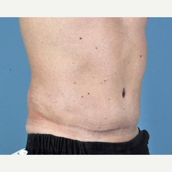 35-44 year old man treated with Tummy Tuck after 3837582