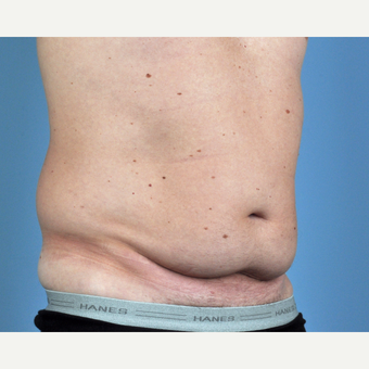 35-44 year old man treated with Tummy Tuck before 3837582