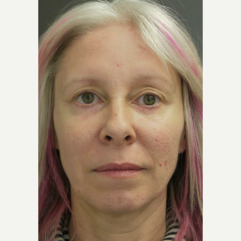 35-44 year old woman treated with Midface Lift after 3703999