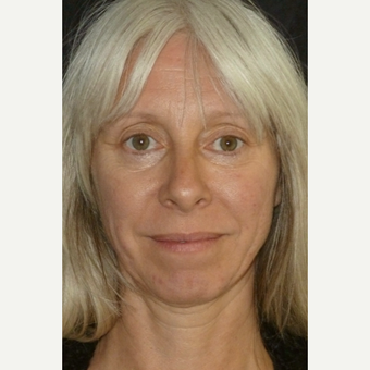 35-44 year old woman treated with Midface Lift before 3703999