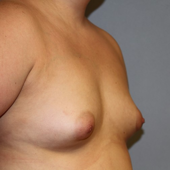 45-54 year old woman treated with Breast Implants before 2878086