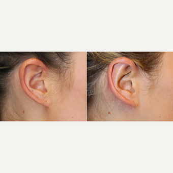 23 year-old female before and 3 months after Ear Surgery (Otoplasty) before 3441471