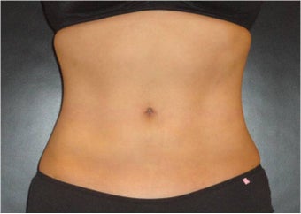 SmartLipo MPX with PRO-Sculpt after 686032