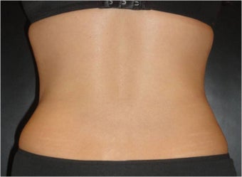 SmartLipo MPX with PRO-Sculpt 686032