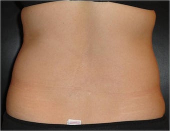 SmartLipo MPX with PRO-Sculpt 686032
