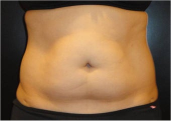 SmartLipo MPX with PRO-Sculpt before 686032
