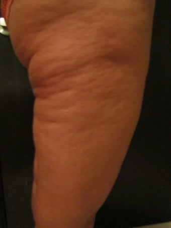 Venus Freeze of the Thighs before 967638