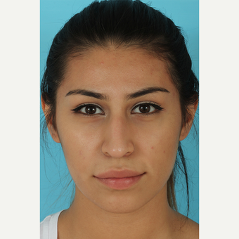 25-34 year old woman treated with Rhinoplasty before 3691040