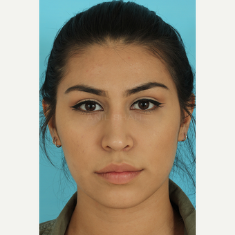 25-34 year old woman treated with Rhinoplasty after 3691040