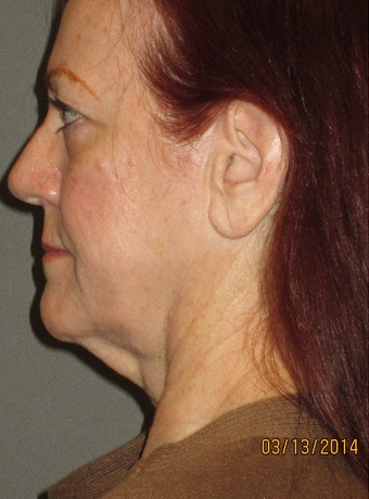 45-54 year old woman treated with Neck Lift before 2241519