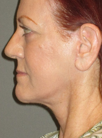 45-54 year old woman treated with Neck Lift after 2241519