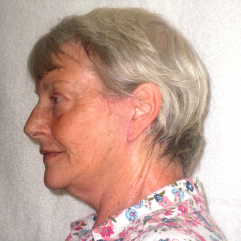 65-74 year old woman treated with Facelift after 3602947