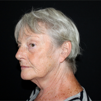 65-74 year old woman treated with Facelift before 3602947