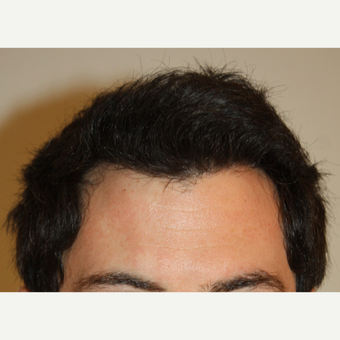 25-34 year old man treated with FUE Hair Transplant after 3645953