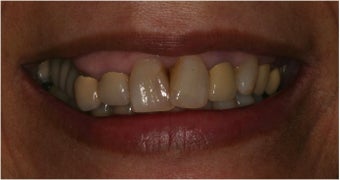 58 Year Old Female treat with Full Mouth Revitalization: before 1352169