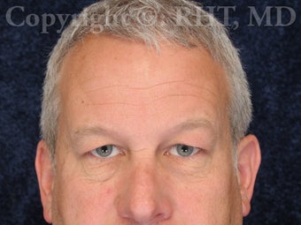 55 year old gentleman treated for brow droop, upper and lower eyelid skin excess. before 1355031
