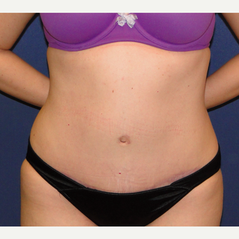 35-44 year old woman treated with Tummy Tuck after 3240891