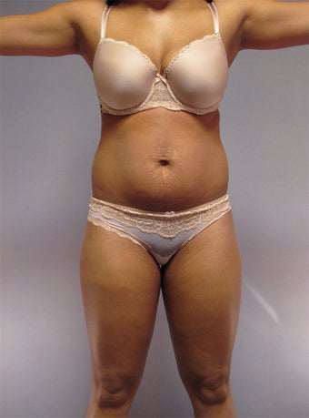 30-Year-Old Female Tummy Tuck / Liposuction 1507543