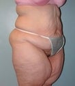 Female patient who underwent a body lift 925308