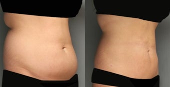 SmartLipo Liposuction before 277340