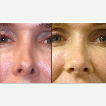 35-44 year old woman treated with Non Surgical Nose Job before 3847095