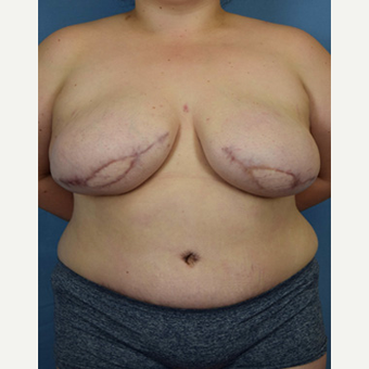 25-34 year old woman treated with Breast Reconstruction after 3650626