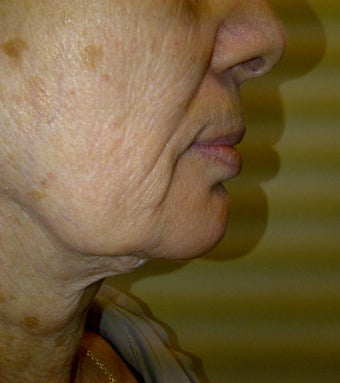 lower face lift approach can improve both the jaw and neck appearance before 1039229