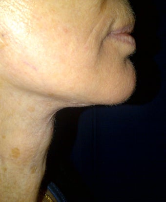 lower face lift approach can improve both the jaw and neck appearance after 1039229