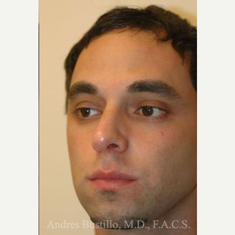 29 year old man treated with Rhinoplasty after 3462398