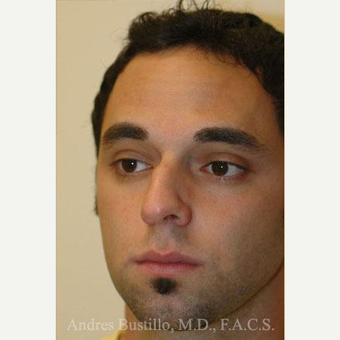 29 year old man treated with Rhinoplasty before 3462398