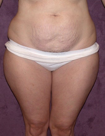 Tummy Tuck before 267722