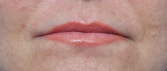 53 year old Patient received Lip Augmentation after 3658354