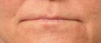 53 year old Patient received Lip Augmentation before 3658354