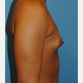 250 cc silicone implants - submuscular = A to full B before 3077439