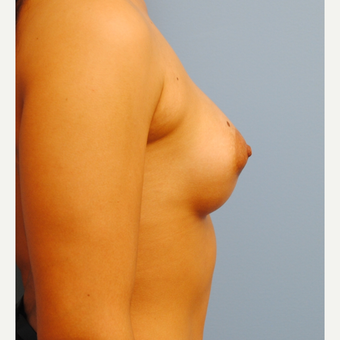 250 cc silicone implants - submuscular = A to full B after 3077439