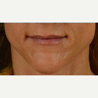 45-54 year old woman treated with Restylane after 3109347