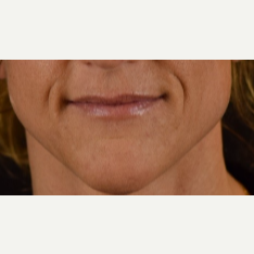 45-54 year old woman treated with Restylane before 3109347