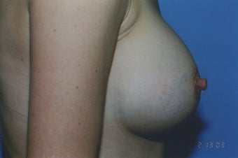 38 Year Old Female with sub muscular 350 cc Saline implants 1364259