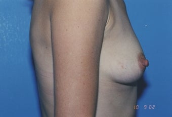 38 Year Old Female with sub muscular 350 cc Saline implants 1364259