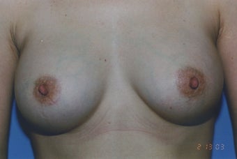 38 Year Old Female with sub muscular 350 cc Saline implants after 1364259