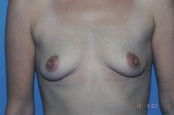 38 Year Old Female with sub muscular 350 cc Saline implants before 1364259