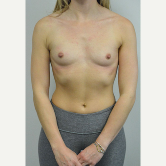 25-34 year old woman treated with Breast Augmentation who wants a natural look before 3644542
