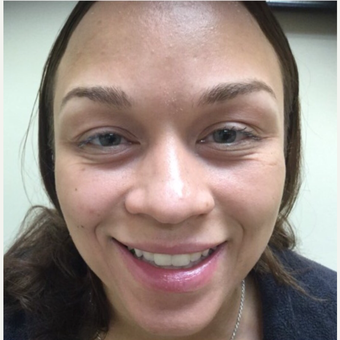 25-34 year old woman treated with Botox before 3443835
